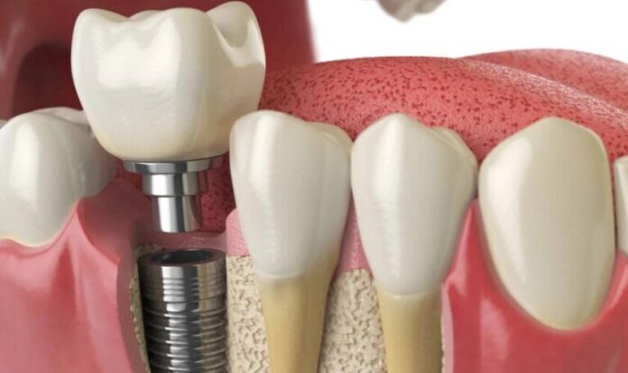 How Supplemental Dental Plans Fit Into Your Health Strategy How Supplemental Dental Plans Fit Into Your Health Strategy